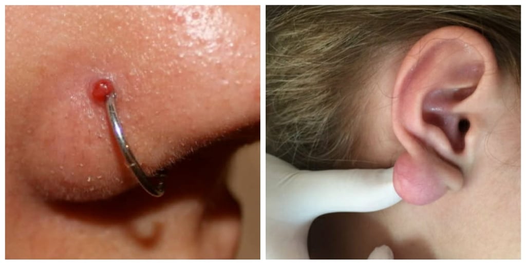 w1024-79 Imagem de um piercing no nariz com irritação e outra de uma orelha com inchaço no lóbulo.