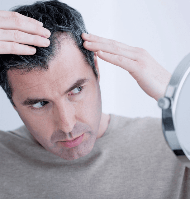 calvicie-homens calvicie homens