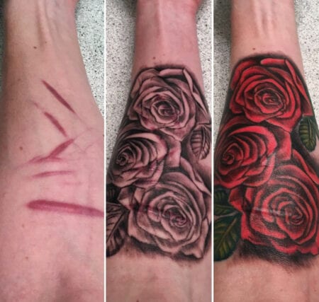 rosa em cicatriz com antes e depois 450x427 1